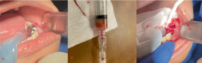The Kang Appliance: A Novel Tooth-Borne Approach to Decompression of Dentigerous Cysts in Pediatric Patients.