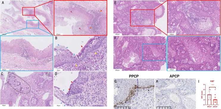 Comparative analysis of clinical features, methylation and immune microenvironment in pediatric and adult papillary craniopharyngiomas: results from a multicenter study.