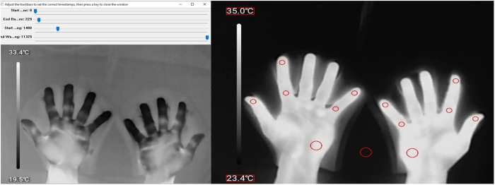 Pre-clinical evaluation of a low-cost tool for skin temperature measurements as a proxy to assess autonomic nerve function in leprosy neuropathy.