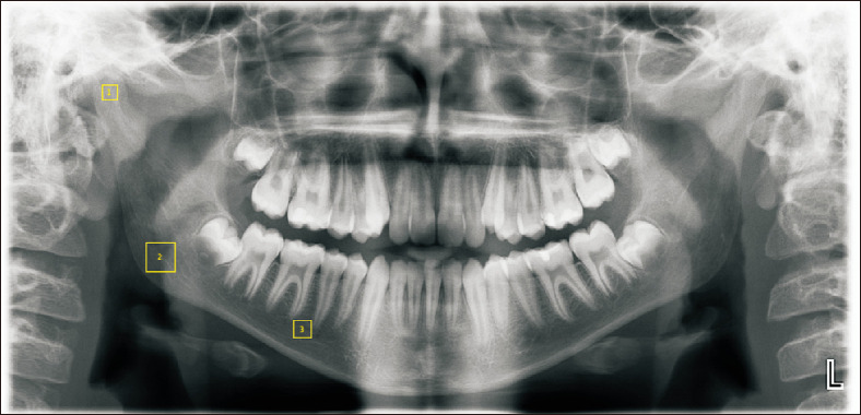 Fractal analysis of mandibular bone structure in individuals with unilateral crossbite.