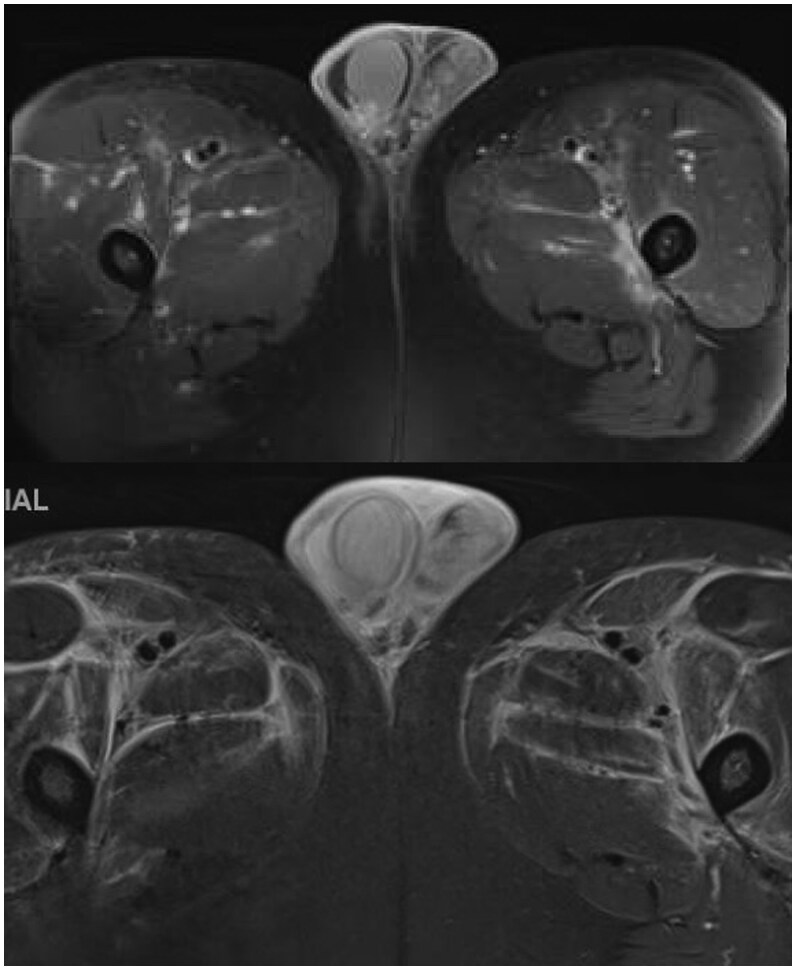 Polyarteritis nodosa with testicular involvement: a rare case report highlighting the role of nuclear imaging and angiography in diagnosis.