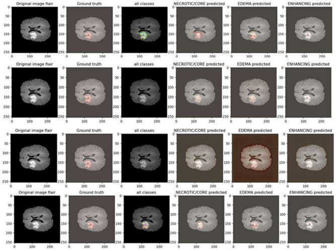 A novel hybrid vision UNet architecture for brain tumor segmentation and classification.