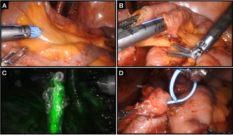 Salvage robotic-assisted radical cystectomy is safe in patients with history of pelvic irradiation.