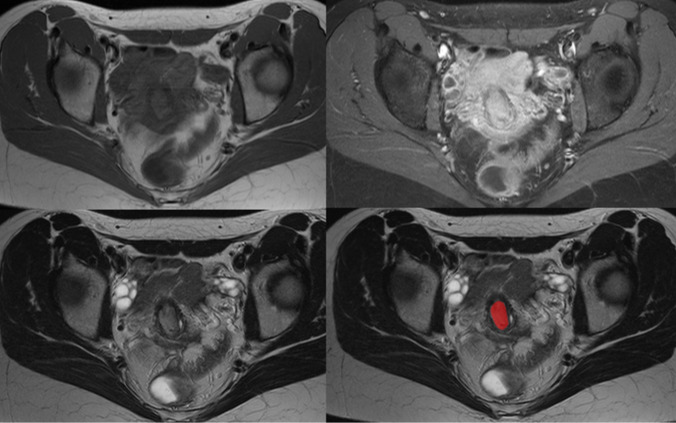 Associations between MRI radiomics analysis and tumor-micro milieu in uterine cervical cancer.