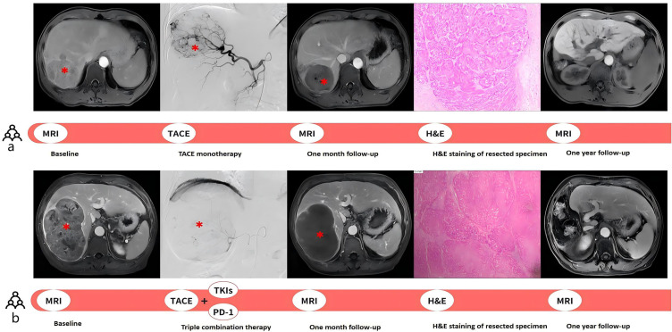 TACE Combined with Lenvatinib-PD-1 Versus TACE Monotherapy as Conversion Therapy Before Liver Resection in Unresectable Hepatocellular Carcinoma: A Retrospective, Propensity Score Matching Study.