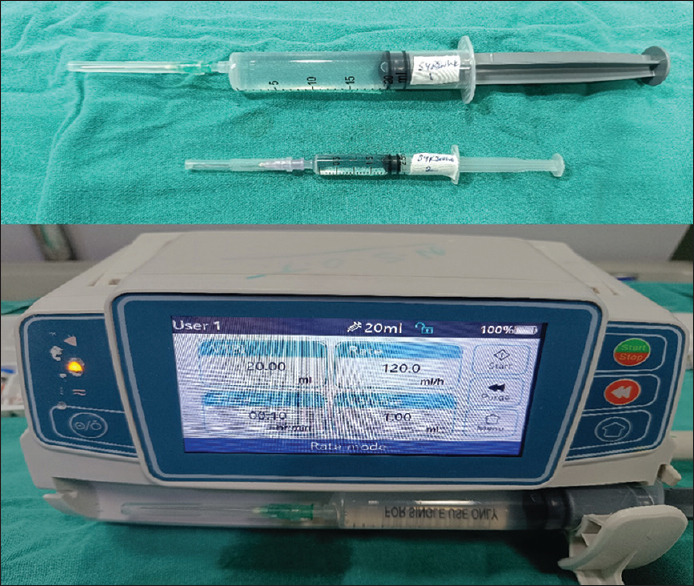 Dexmedetomidine vs. midazolam-ketamine for sedation during awake fiberoptic nasal intubation in patients with difficult airway - A randomized, double-blinded, comparative trial.