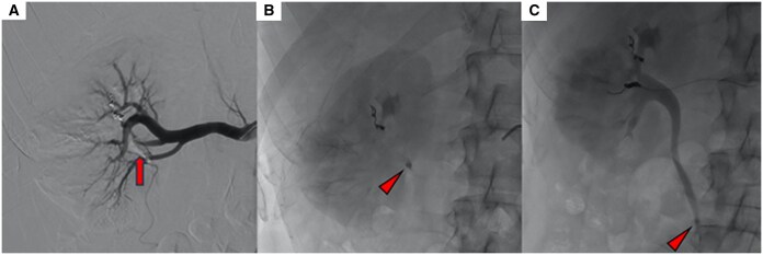 An unusual renal colic during trans-arterial embolization after trauma and its multidisciplinary management.