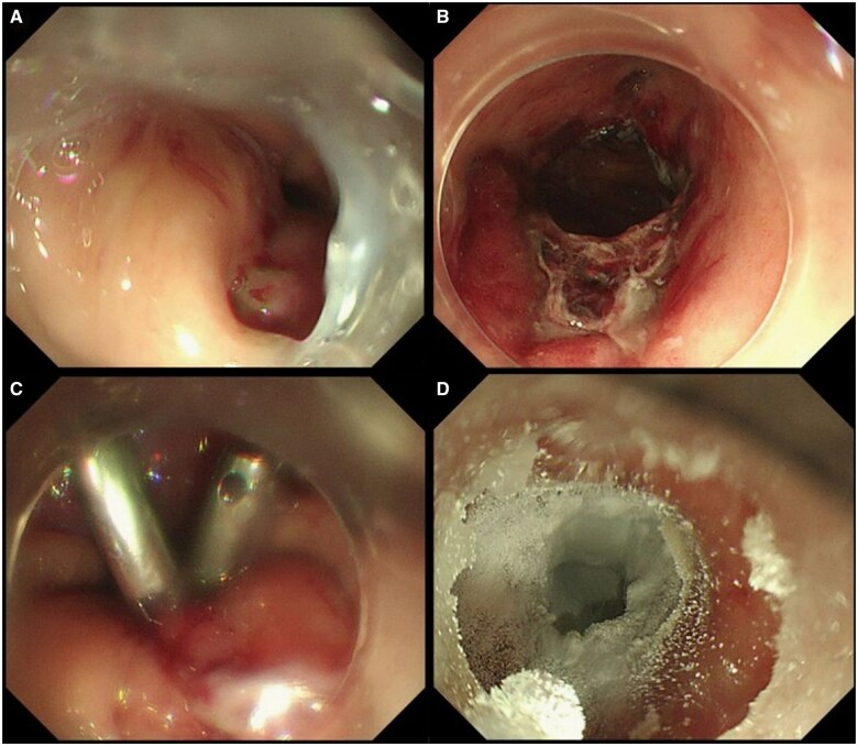 Upper gastrointestinal bleeding after Roux-en-Y gastric bypass: Mallory-Weiss syndrome with marginal ulcer.