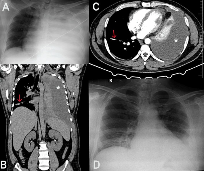 Chylothorax in Uncommon Contexts: Pulmonary Tuberculosis and Mantle Cell Lymphoma.