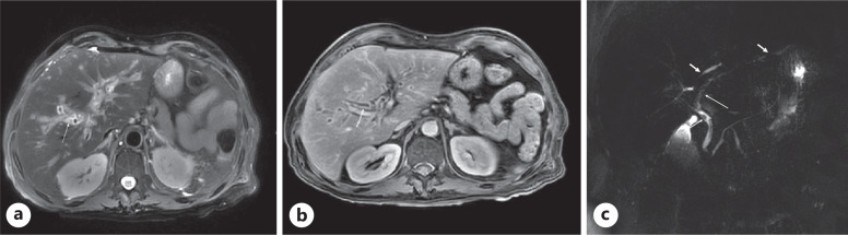 COVID-19 Induced Cholangiopathy: A Case Report.