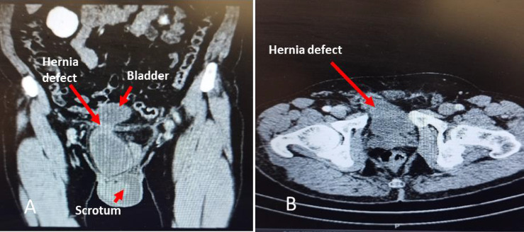 Laparoscopic Management of a Recurrent, Inguinal Hernia Containing Urinary Bladder: A Case Report and Literature Review.