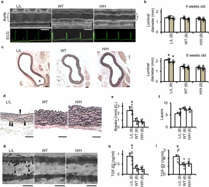 Proximal aortic aneurysms in mice underexpressing transforming growth factor-β1.