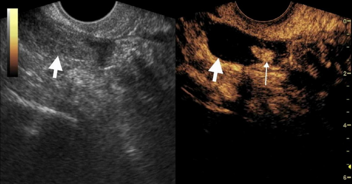 Contrast enhanced ultrasound - a useful method for diagnosing tubal ectopic pregnancy with low level β-HCG.