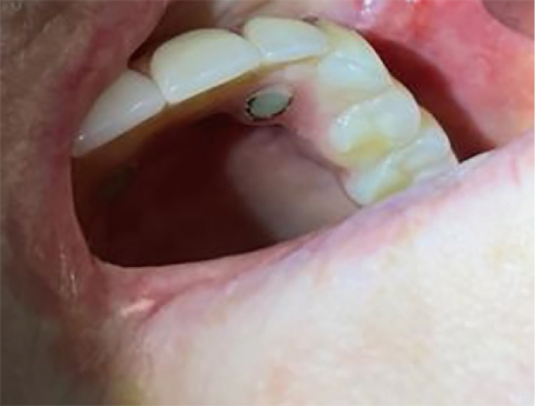 Case report of long-term disease control of recurrent intraoral basal cell carcinoma with vismodegib at two-year follow-up.