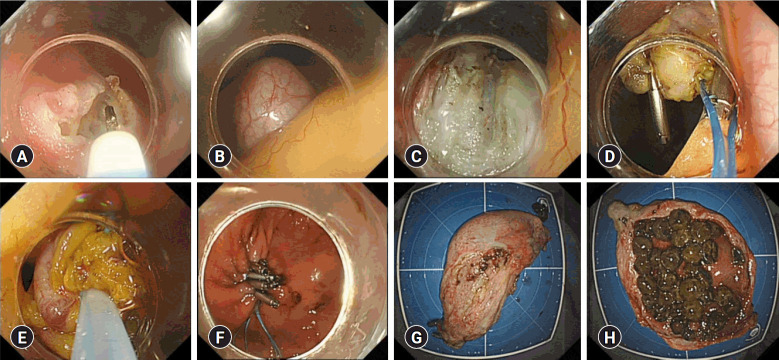 True natural orifice transluminal endoscopic surgery-transgastric cholecystectomy and beyond.