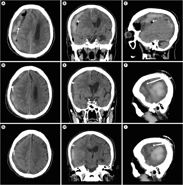 Tailored Tissue Plasminogen Factor Injection via Subdural Catheter for Subacute Subdural Hematoma in an Elderly Patient: A Case Report and Literature Review.
