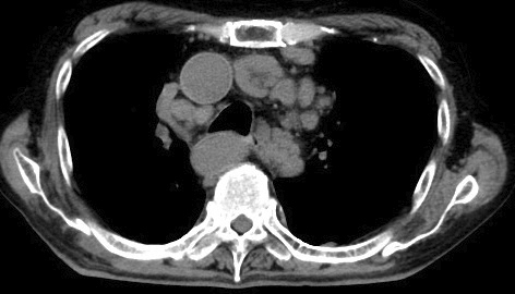 Methotrexate-associated Hodgkin Lymphoma Occurring Decades after Methotrexate Initiation.