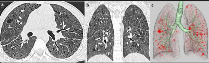 The lost chILD: a case report of delayed diagnosis of surfactant protein C deficiency in a 15-year-old African male.
