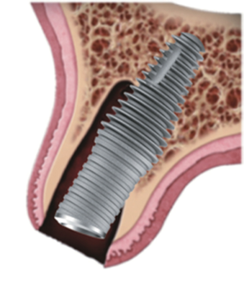 A Retrospective Study Using a Novel Body-Shift Implant Design with a Novel Alloplastic Particulate Grafting Material in Immediate Extraction Sockets.