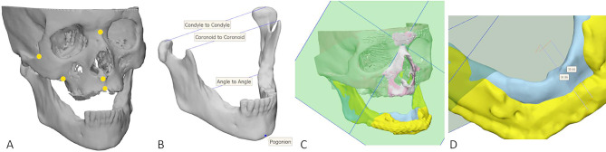 Mandibular reconstruction outcomes for in-house patient-specific solutions.