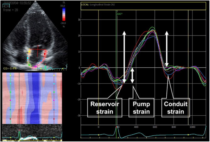 Left atrium phasic function decreases in adult patients with repaired tetralogy of fallot: a case-control study.