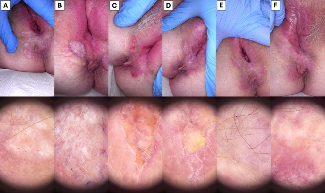 High-Intensity Focused Ultrasound (HIFU) Treatment of Vulvar Lichen Sclerosus.