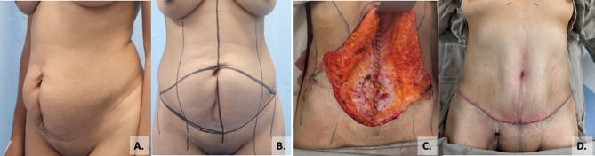 Clinical and perioperative outcomes of abdominal wall reconstruction and panniculectomy in a single surgical procedure: experience from a high-complexity center in bogotá, Colombia.