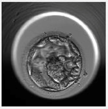 A Rare Case of Live Birth Through In Vitro Fertilization in a 46-Year-Old Woman Using Her Autologous Oocytes: Case Report and Literature Review.