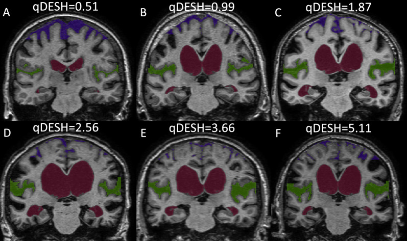 qDESH: a method to quantify disproportionately enlarged subarachnoid space hydrocephalus.
