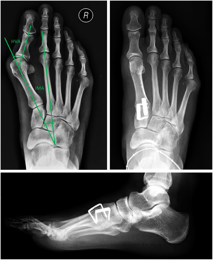Clinical Outcomes of Lapidus Arthrodesis With Nitinol Staples for Hallux Valgus Correction.