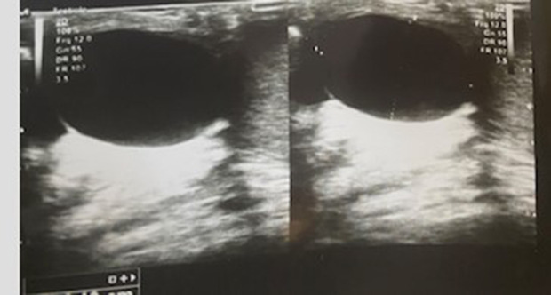 Atypical Testicular Torsion Due to an Epididymal Cyst in a Young Adult: Case Report.