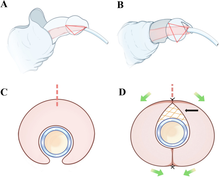 Application of glanular decompression and expansion surgery in proximal hypospadias with hypoplastic glans penis.