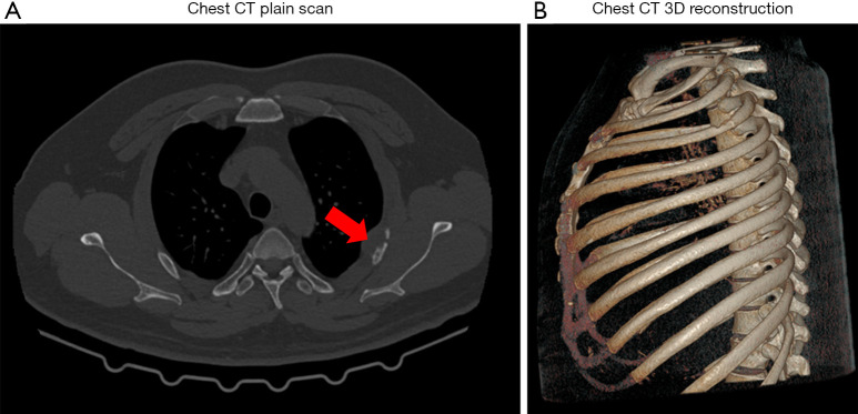 Clinical features and pathological analysis of primary rib Langerhans cell histiocytosis: case series and literature review.