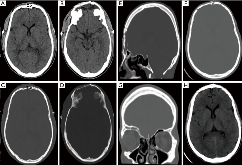 Primary reconstruction of depressed frontal bone fracture including cranialization of frontal sinus and repair of forehead skin: a case report and literature review.