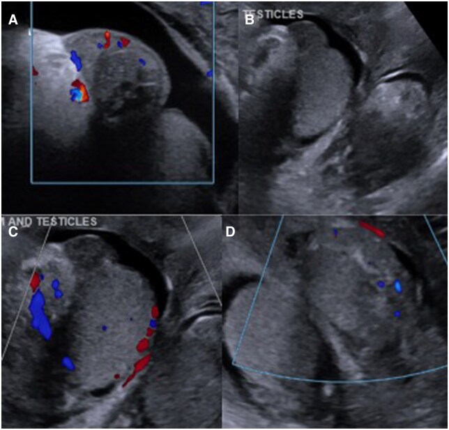 Polyarteritis nodosa with testicular involvement: a rare case report highlighting the role of nuclear imaging and angiography in diagnosis.