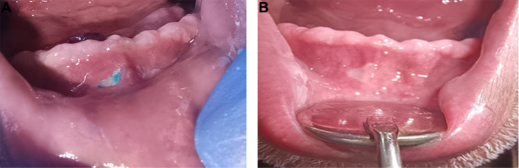 Investigation of traumatic ulcer locations and healing progression during denture adjustment periods in Syrian complete denture patients.