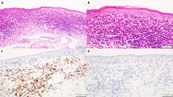 High-Intensity Focused Ultrasound (HIFU) Treatment of Vulvar Lichen Sclerosus.