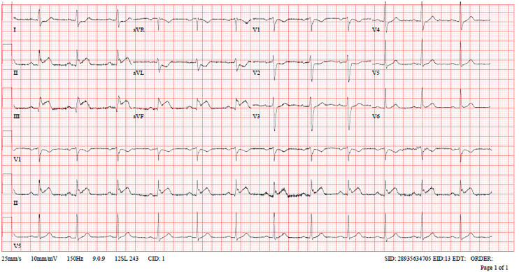 Clomiphene-induced myocardial infarction in a young male: A case report of a rare cardiovascular complication.