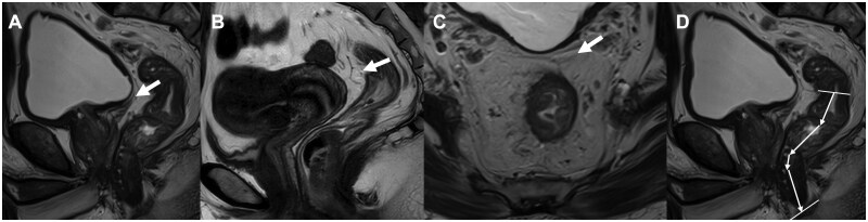 Analysis of the clinical value of anterior peritoneal reflection for the management of rectal cancer.