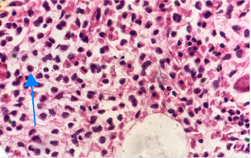 CD103-Negative Hairy Cell Leukemia: A Case Report From University Teaching Hospital, Zambia.