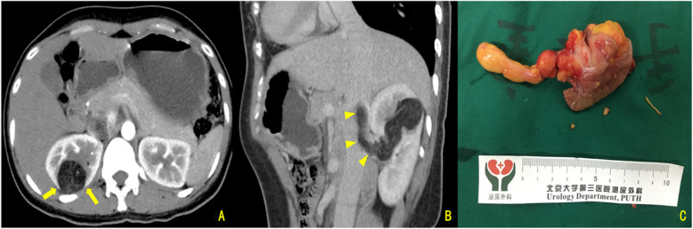 Clinical and imaging characteristics of classic angiomyolipoma with venous tumor thrombosis: a comparative analysis against renal cell carcinoma.