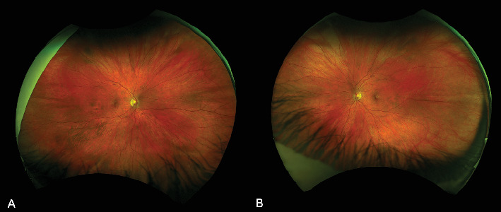 Central Retinal Vein Occlusion Associated With Progestin-Only Contraceptive Implant Use.