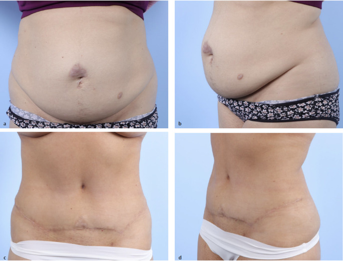 Mesh suture repair of rectus diastasis with and without a concurrent ventral hernia.