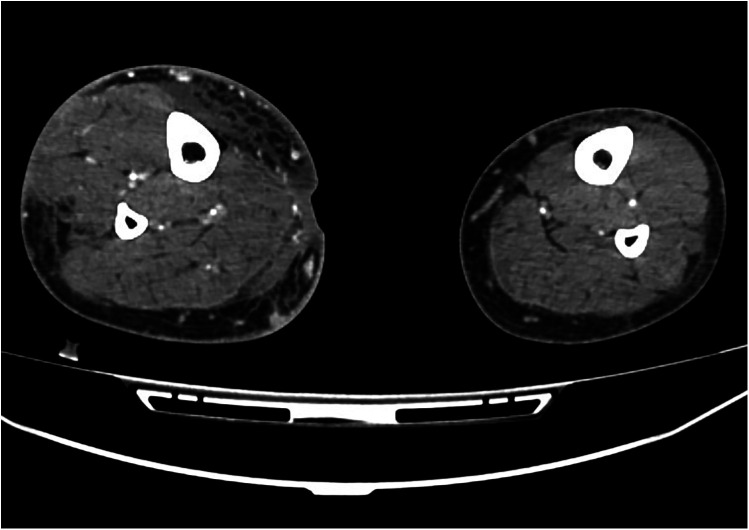 Severe complications following transarterial microembolization for a micro arterio-venous fistula in a patient with chronic venous ulcer: a case report.