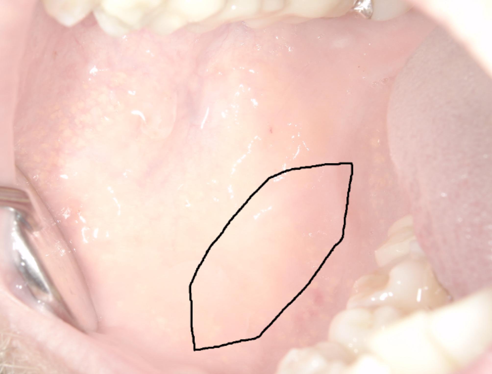 New measurement method for long-term oral complications after harvesting buccal mucosa grafts for urethroplasty.