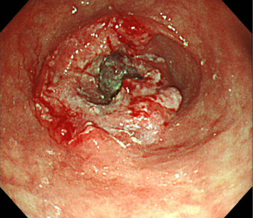 A Case of Ventricular Arrhythmia in a Patient With HER2-Positive Gastric Cancer Receiving Trastuzumab.