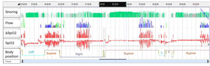 Obstructive Sleep Apnea Syndrome in women: gender in sleep respiratory medicine is a first step towards personalized medicine.