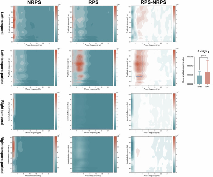 Enhanced theta oscillations in the left temporoparietal region associated with refractory positive symptoms in schizophrenia.