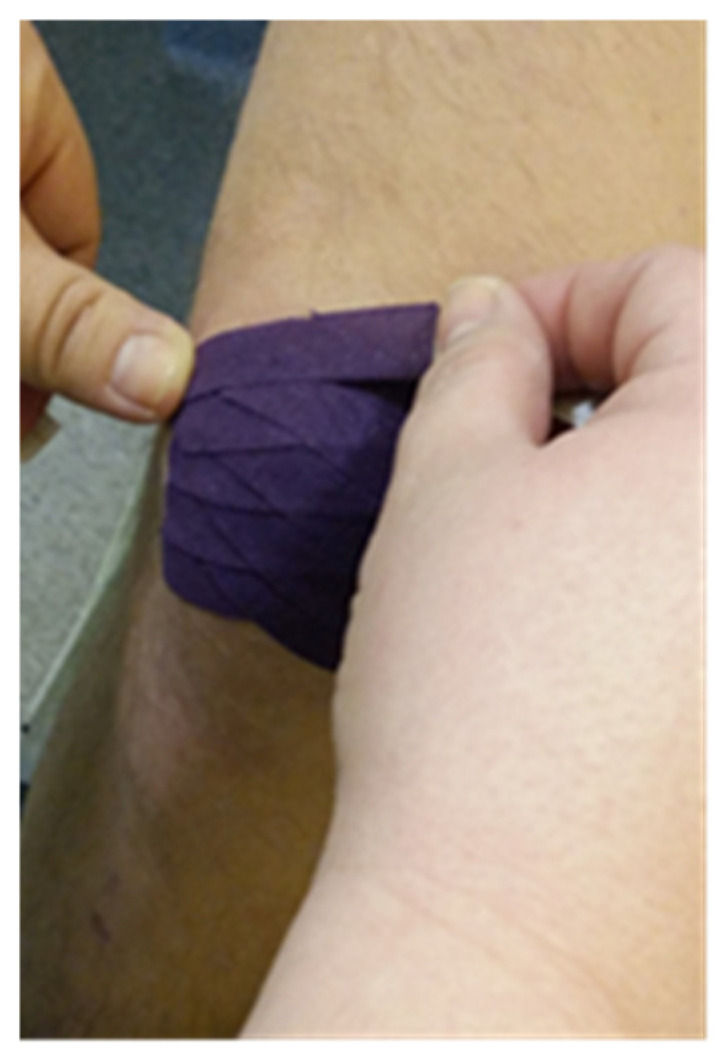 Assessment of the Effect of Kinesiology Taping on Scar Treatment in Children.