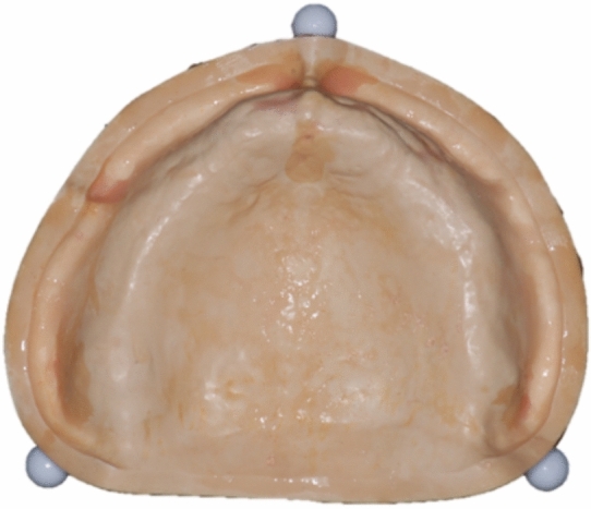 Three dimensional analysis on the deformation of the master cast during maxillary complete denture fabrication.